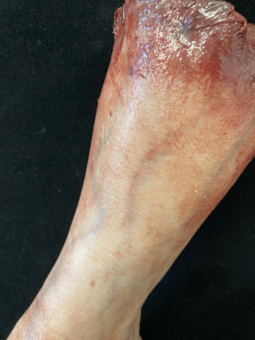 Silicone Severed Leg - Cadaver