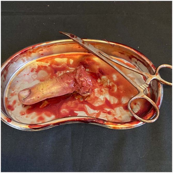 Surgical Tray with Silicone Severed Finger