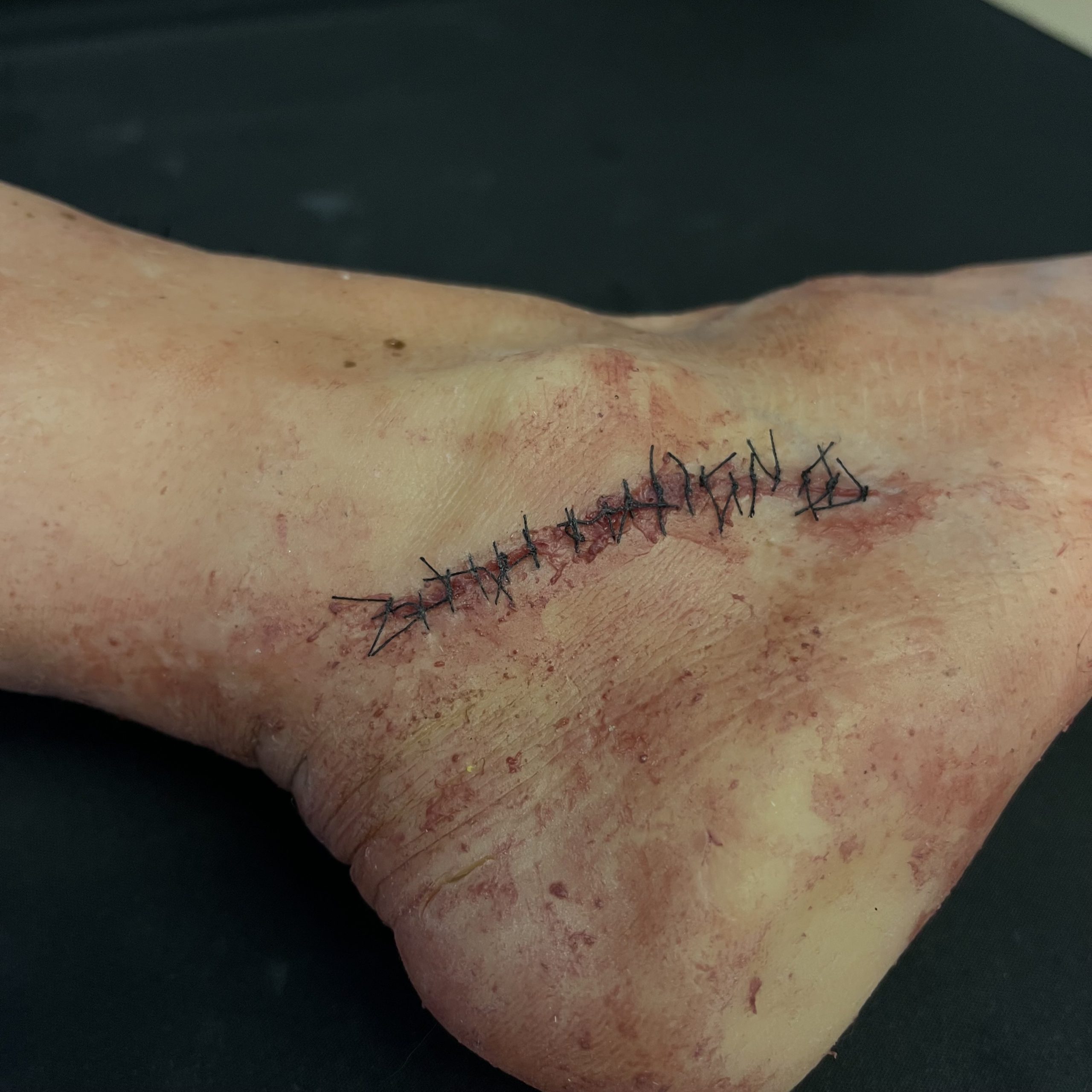 Silicone Severed Leg With Stitches - Male