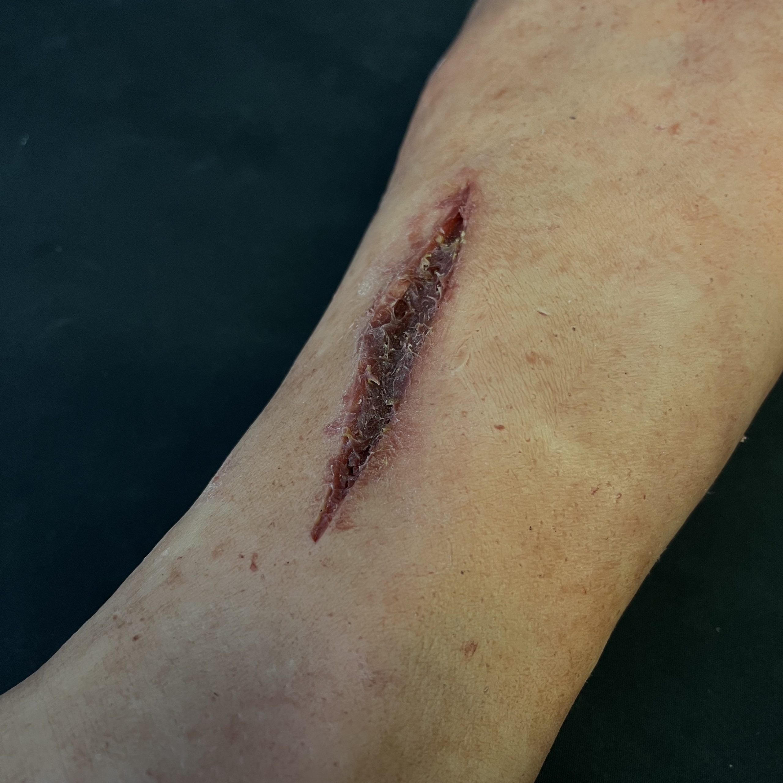 Silicone Severed Leg With Wounds - Male