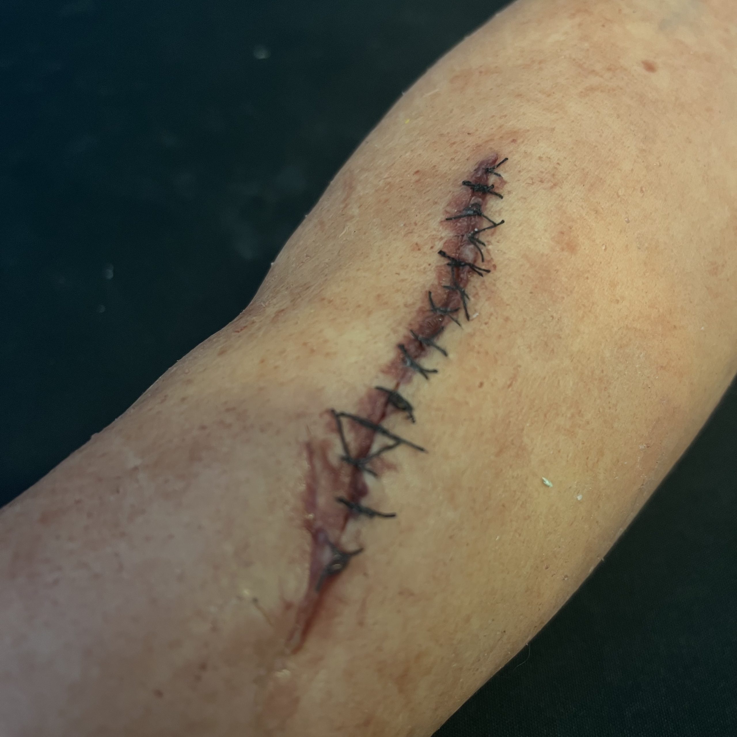 Silicone Severed Full Arm With Stitches - Male