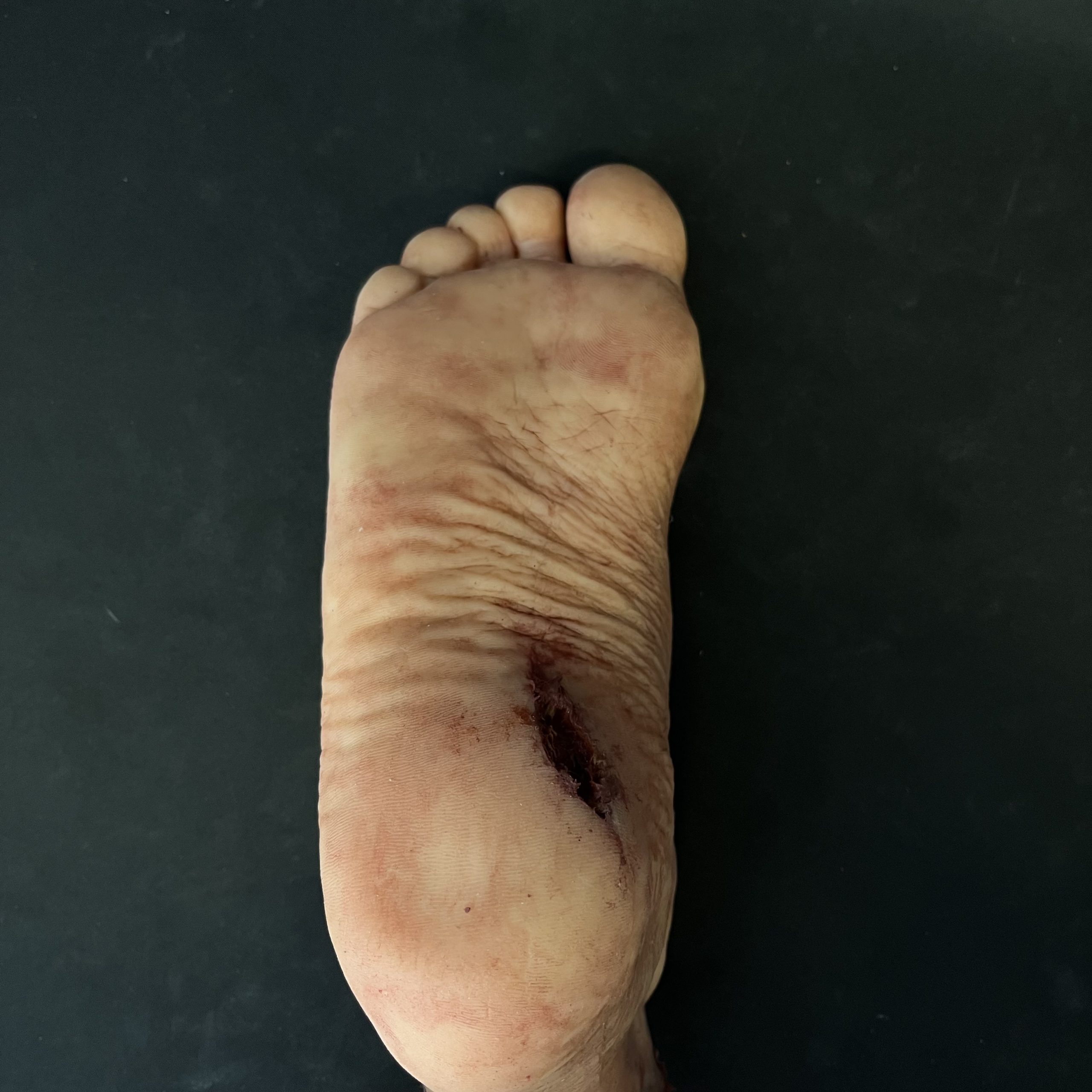 Silicone Severed Foot With Wounds - Male