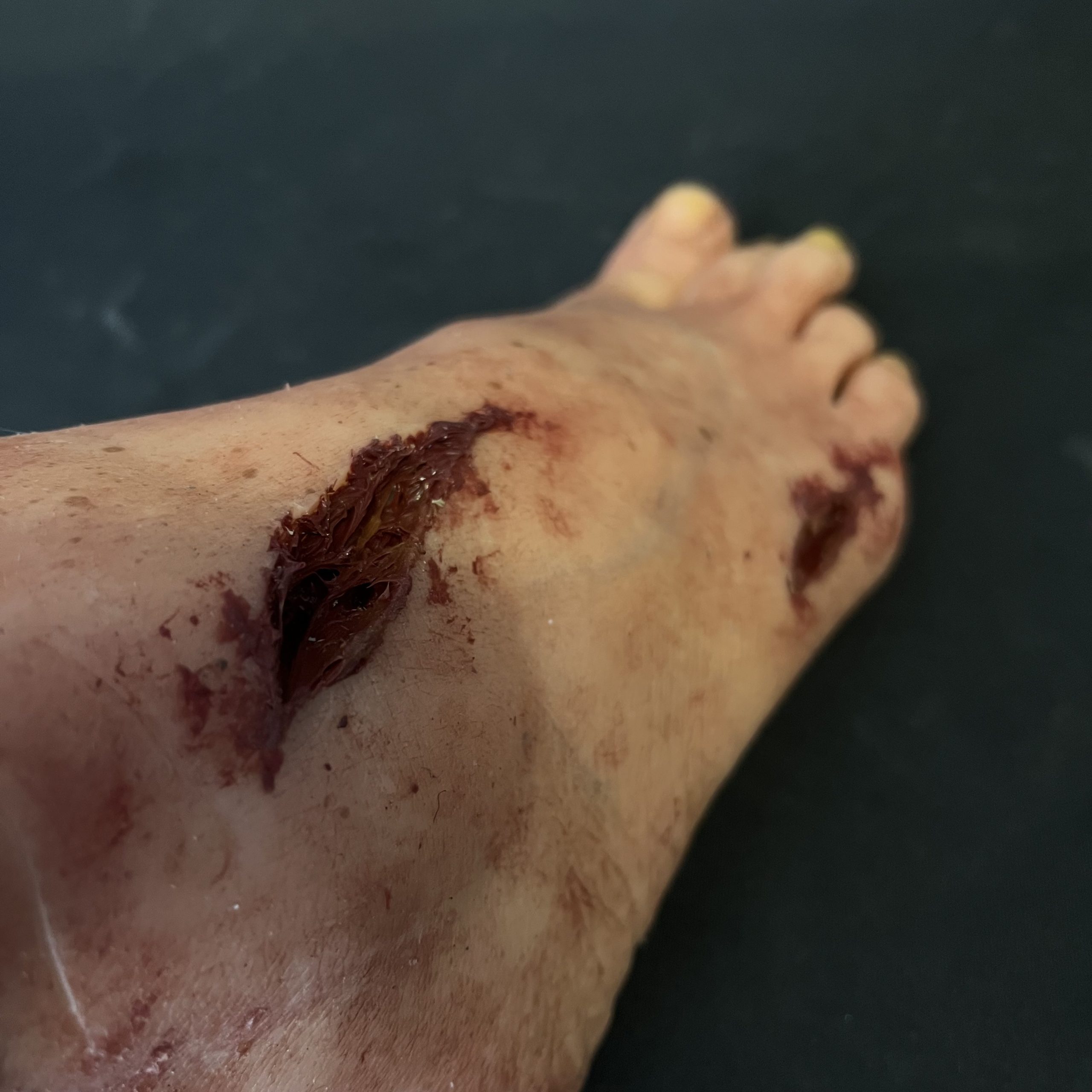 Silicone Severed Foot With Wounds - Female