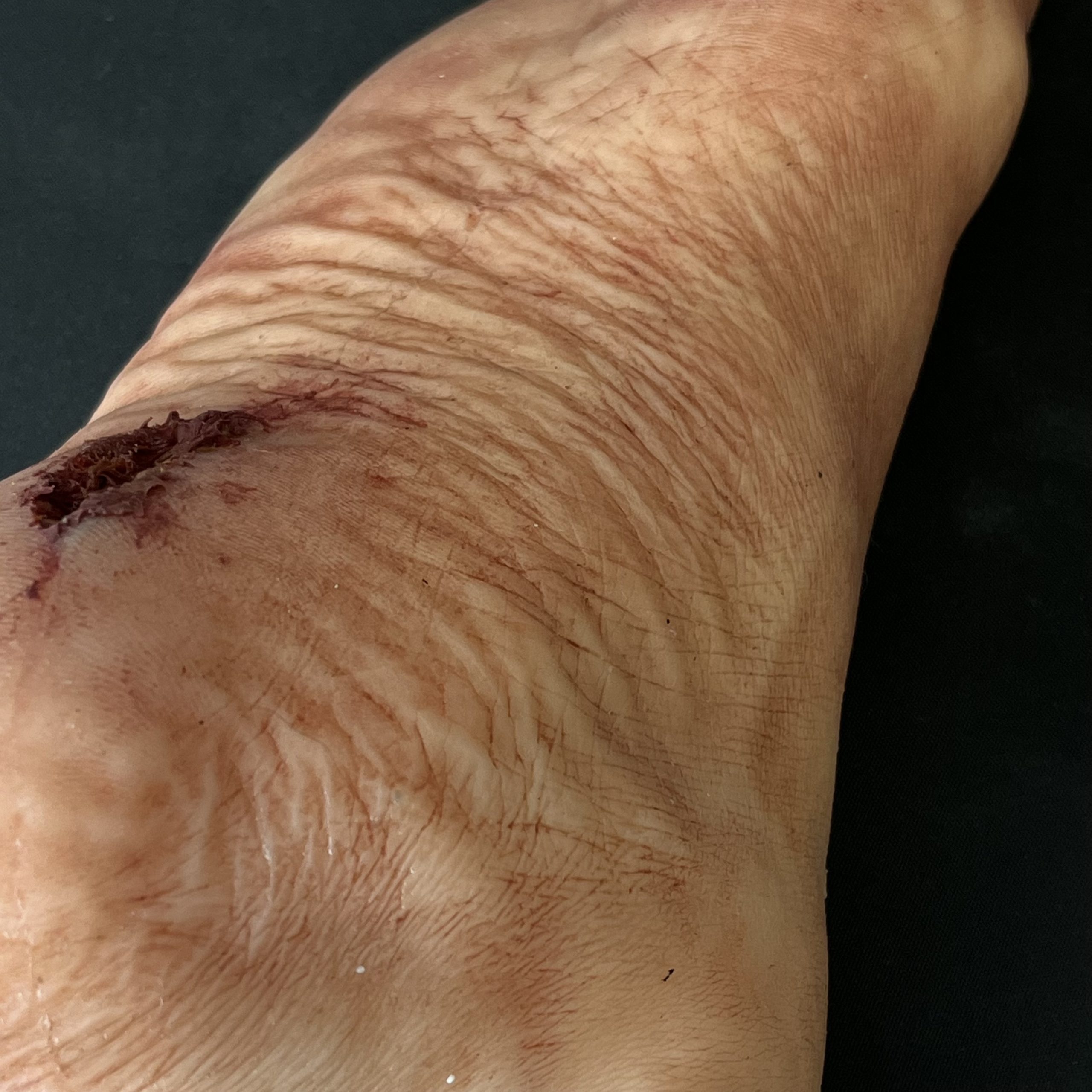 Silicone Severed Foot With Wounds - Male