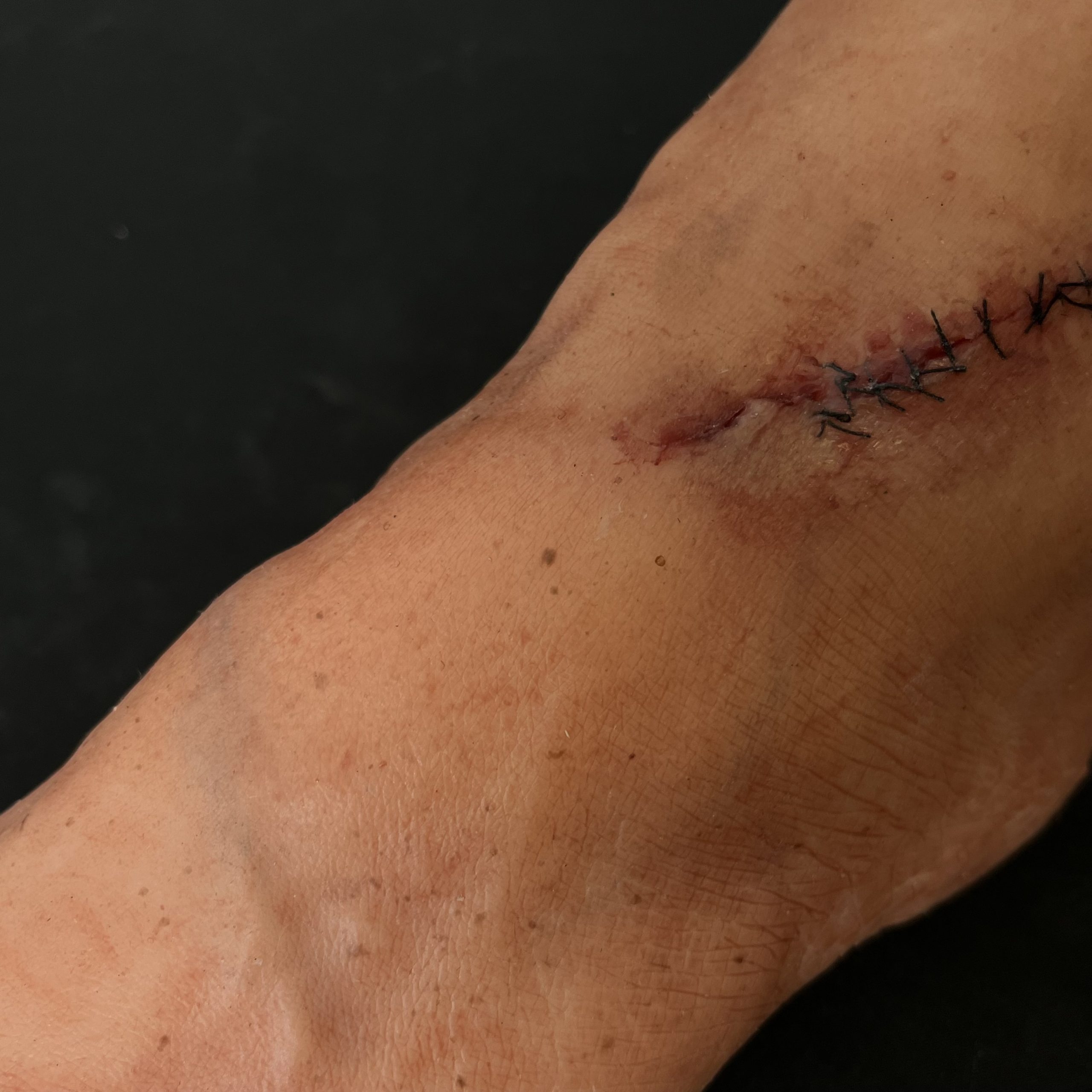 Silicone Severed Leg With Stitches - Male