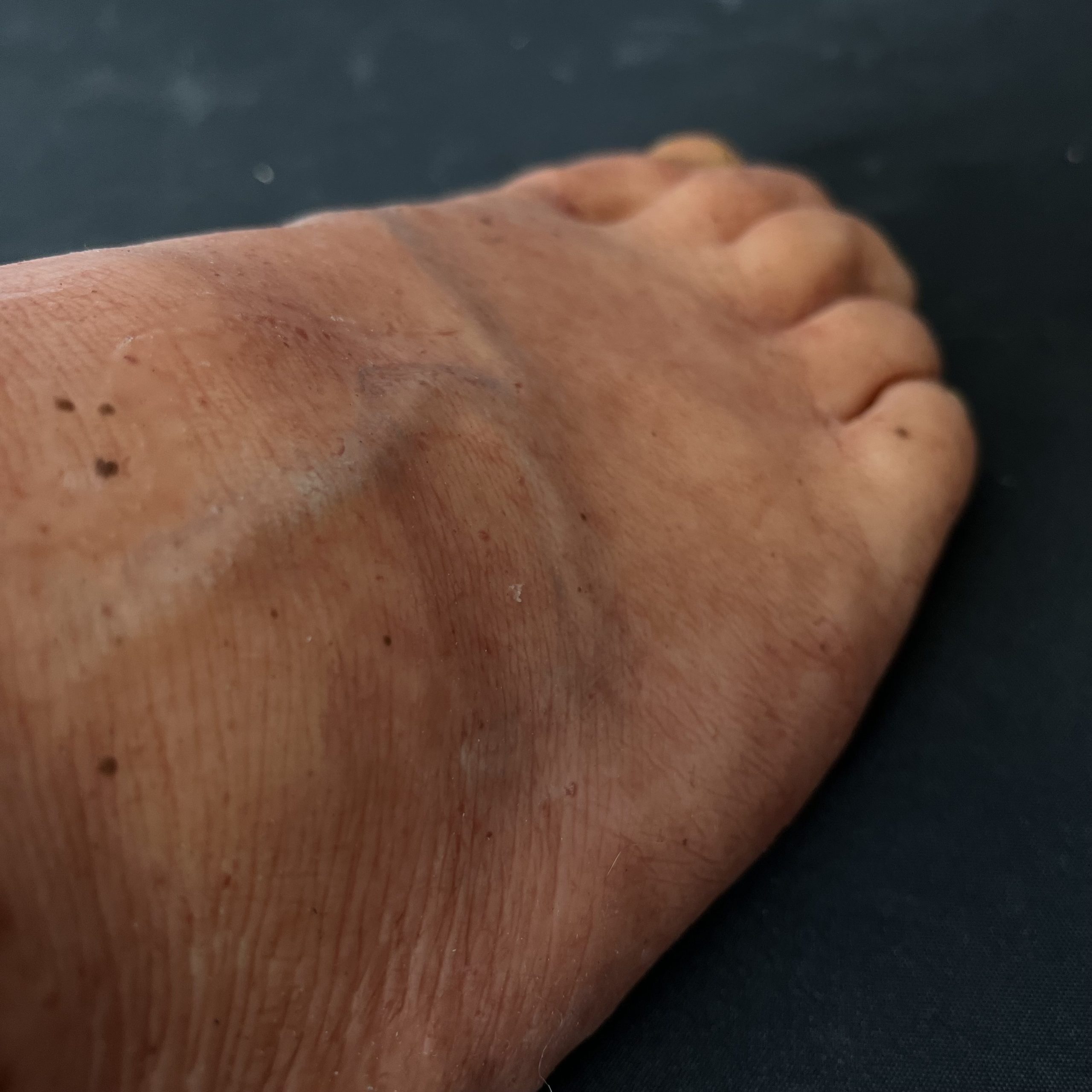 Silicone Severed Leg With Stitches - Female