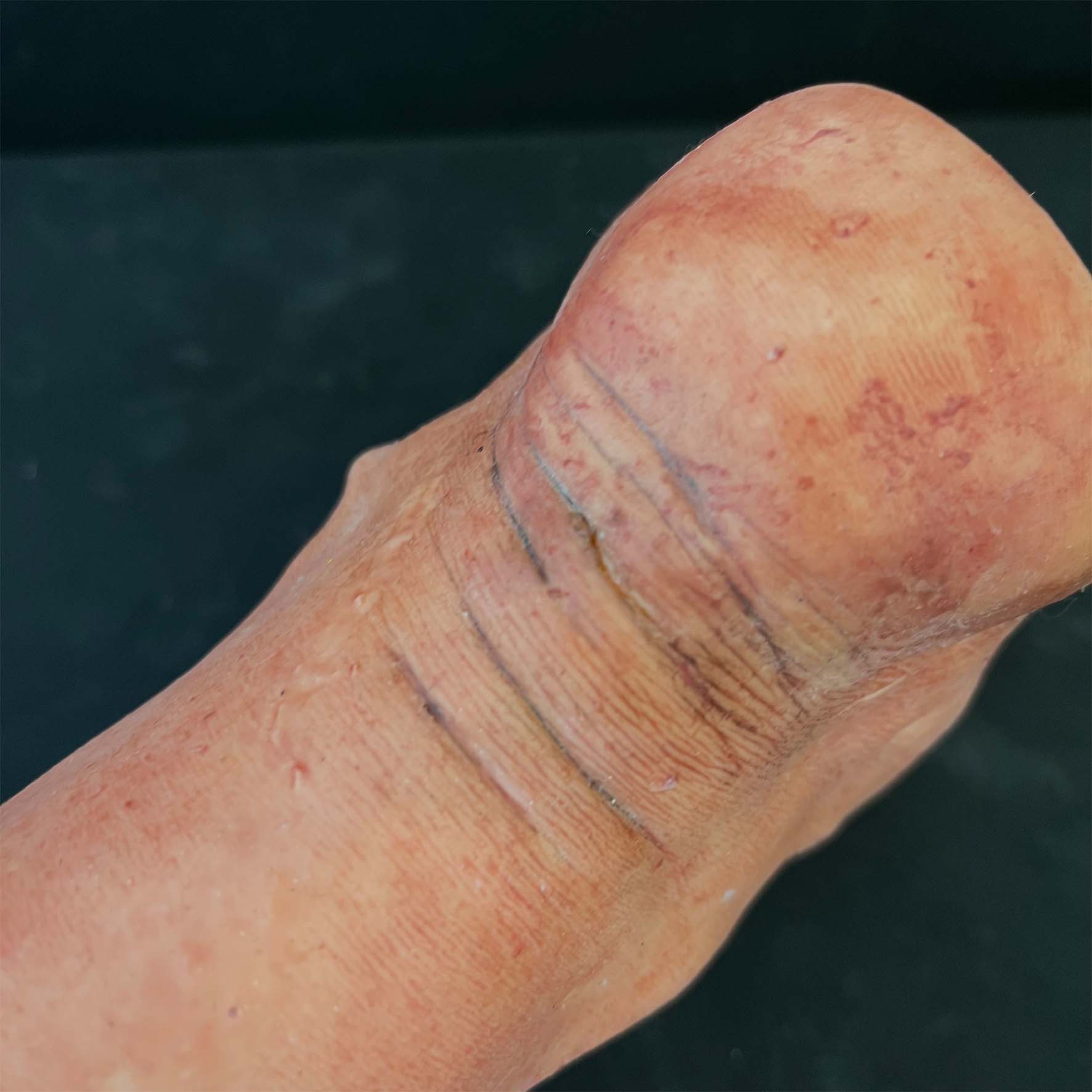 Silicone Severed Leg With Stitches - Female